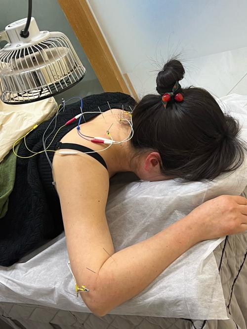 针灸可以治疗颈椎病吗