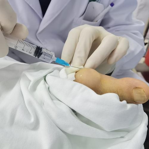 痛风石切除术手术记录