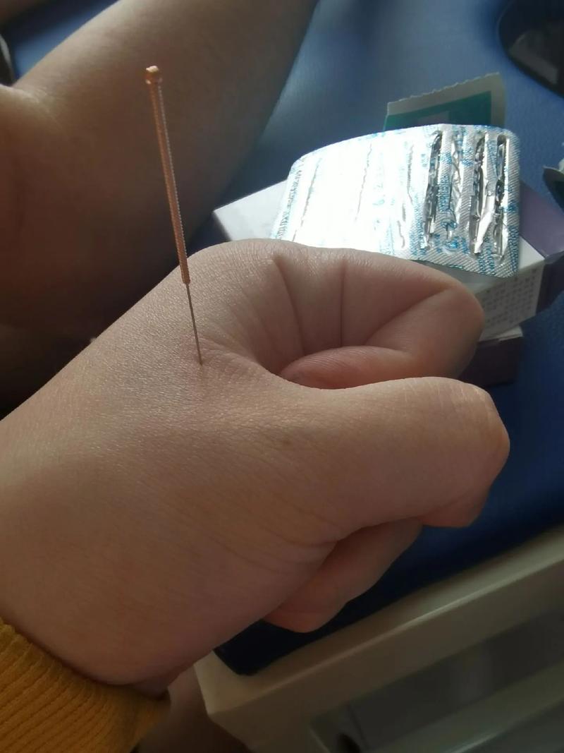 自己可以给自己针灸吗