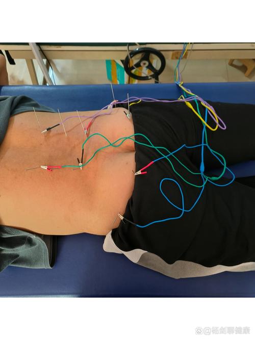 腰椎间盘突出针灸治疗