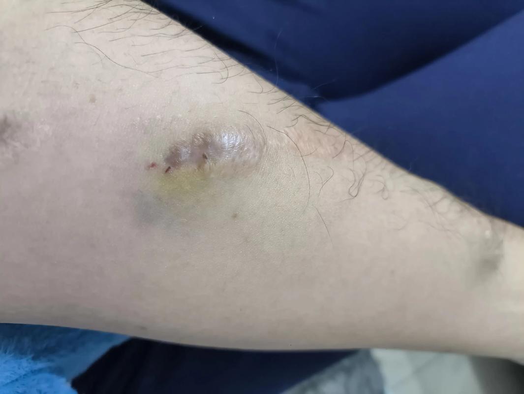 针灸扎出黑血是怎么了