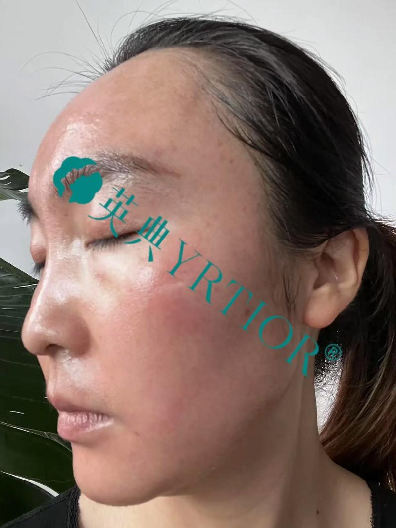 曲中周祛斑是安全的吗