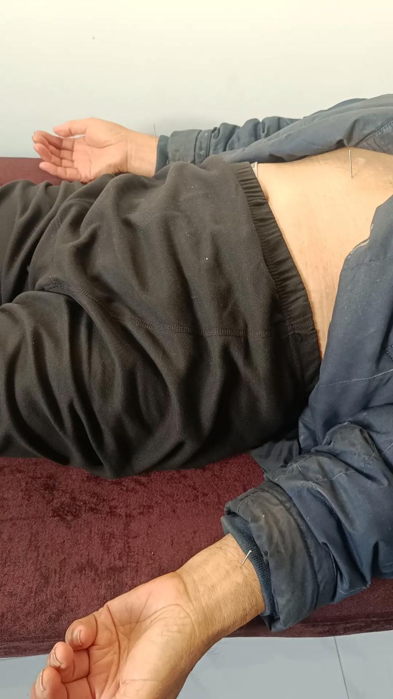 下颌关节紊乱针灸6次