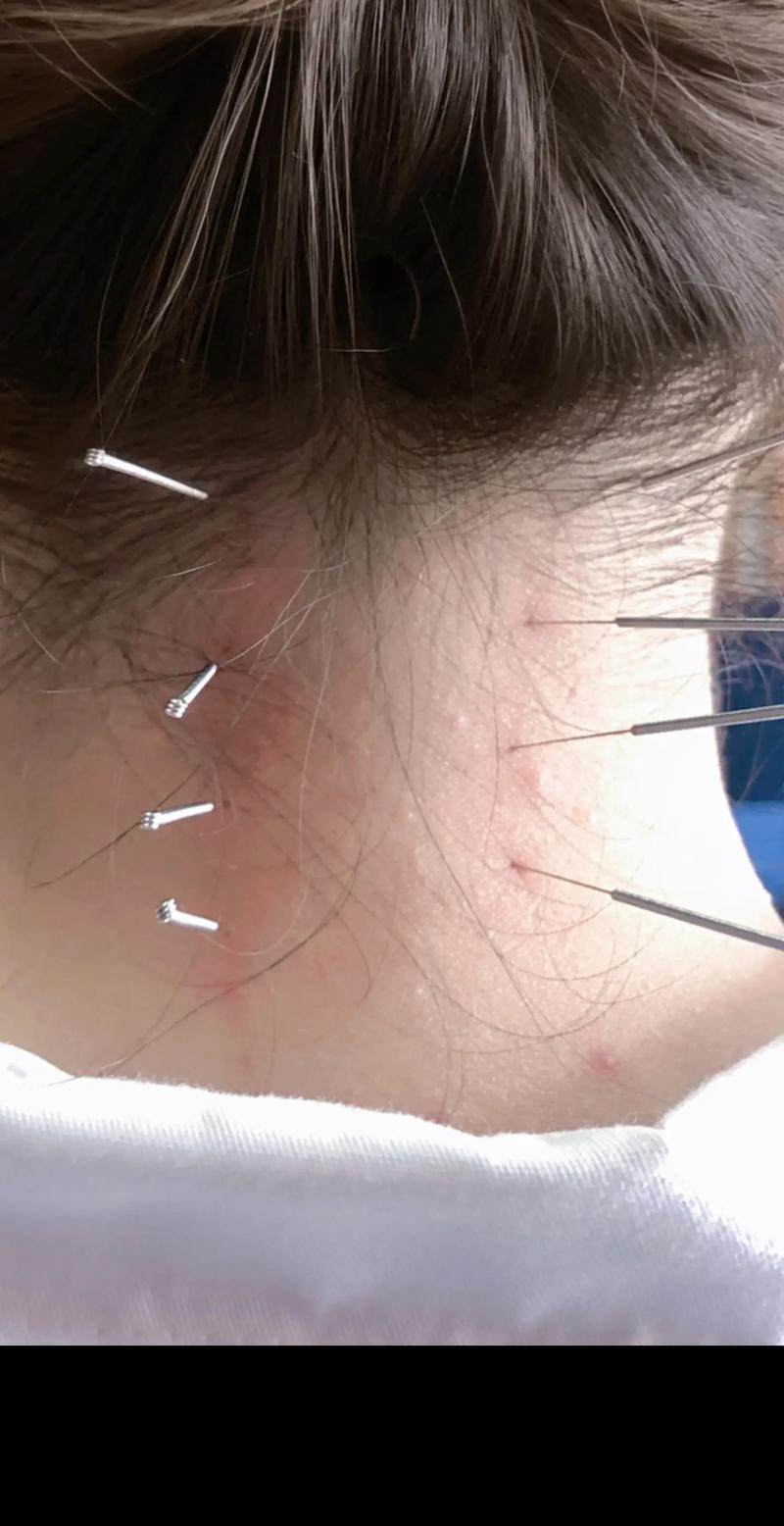 颈椎针灸几次能有效果