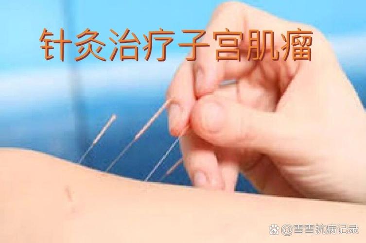 董氏针灸治疗子宫肌瘤