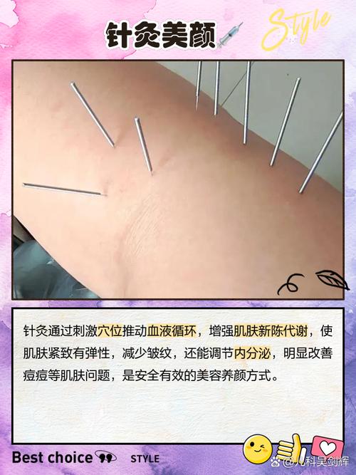 董氏针灸治疗子宫肌瘤