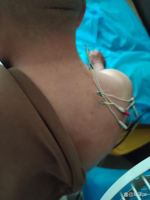 针灸后几小时发生气胸