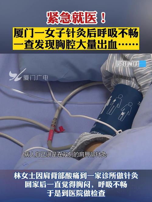 针灸后几小时发生气胸