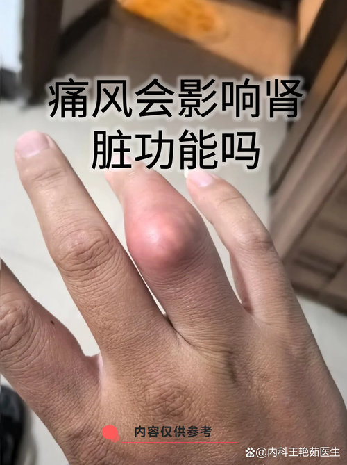 痛风和肾结石有关系吗