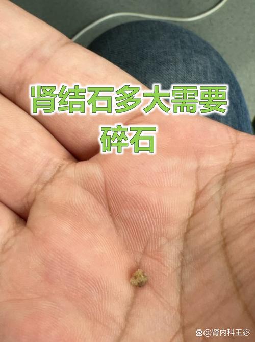 痛风和肾结石有关系吗