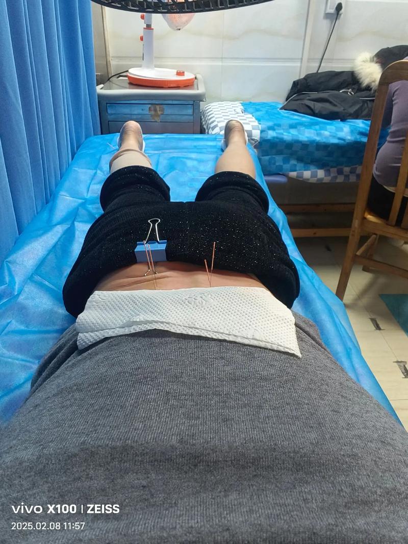 针灸治风湿效果怎么样