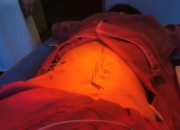 带状疱疹针灸哪些部位