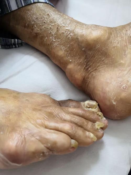 痛风手足泡浴剂在哪买