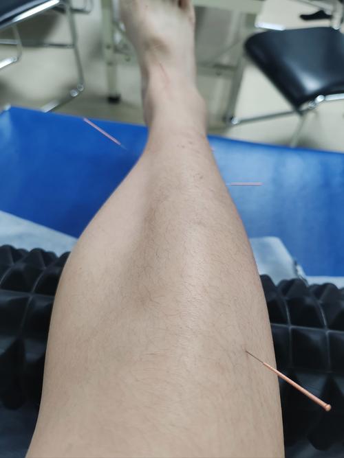 针灸上午好还是下午好