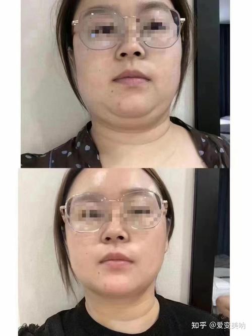 蜜拉贝儿溶脂针安全吗