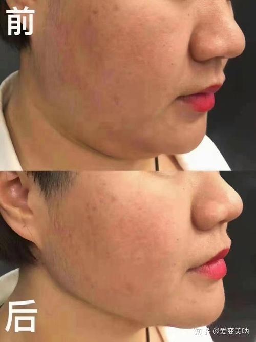 蜜拉贝儿溶脂针安全吗