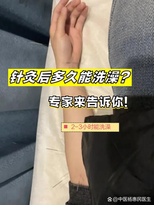 针灸多长时间可以洗澡