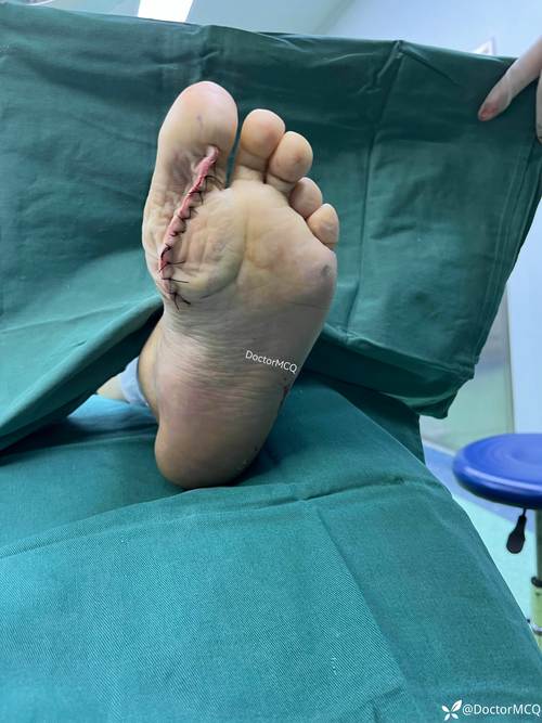 痛风做手术能治疗好吗