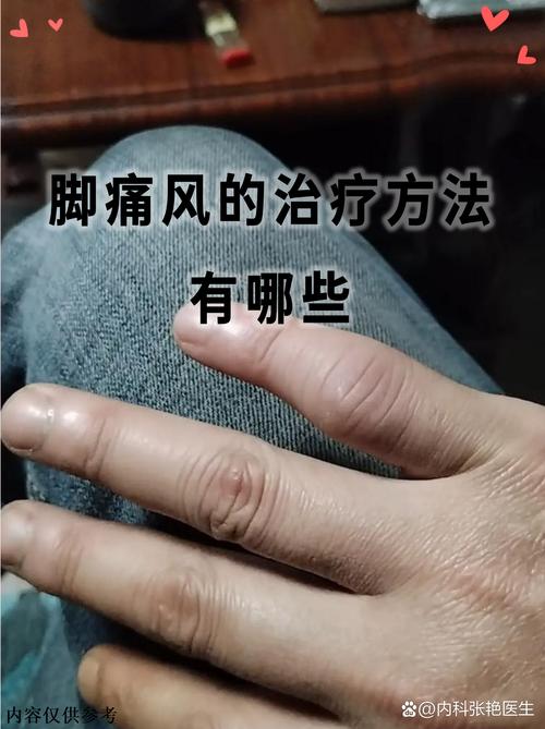 痛风肾上海明珠真不错