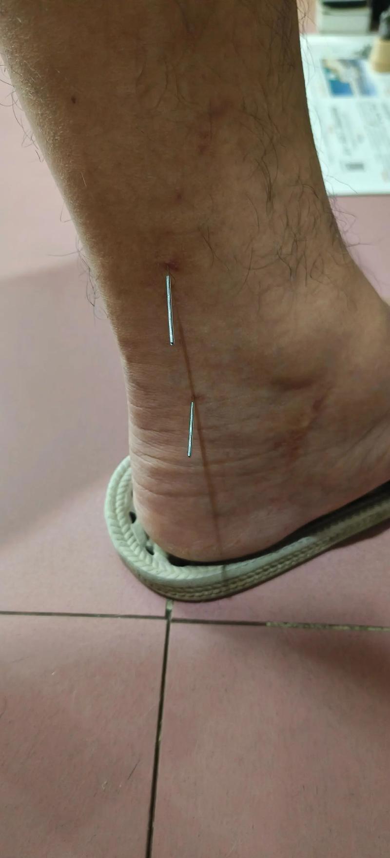 针灸对脚底麻木疼痛