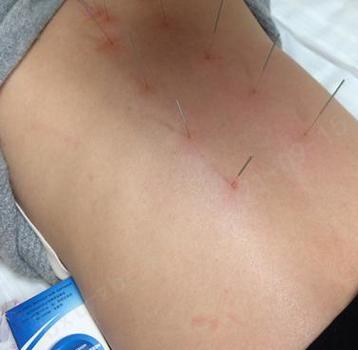 针灸治疗拉肚子婴儿