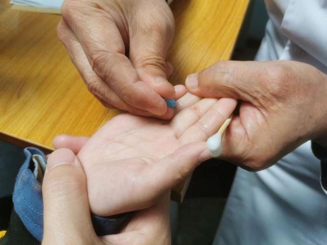 针灸治疗拉肚子婴儿