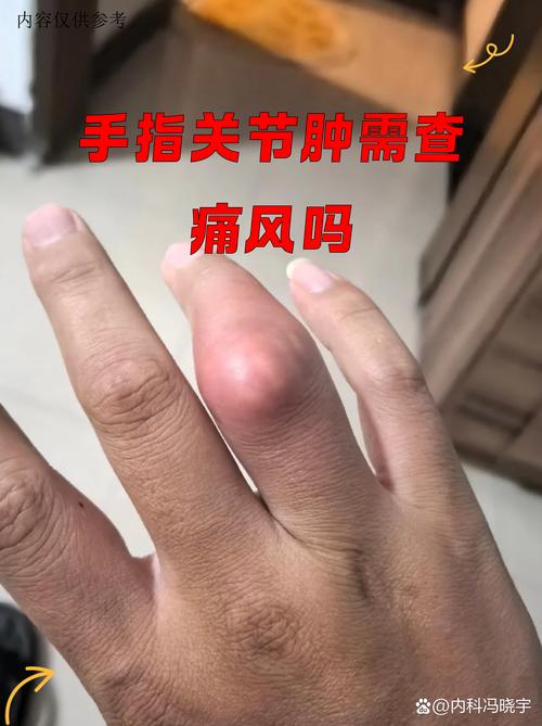 痛风手麻木是怎么回事