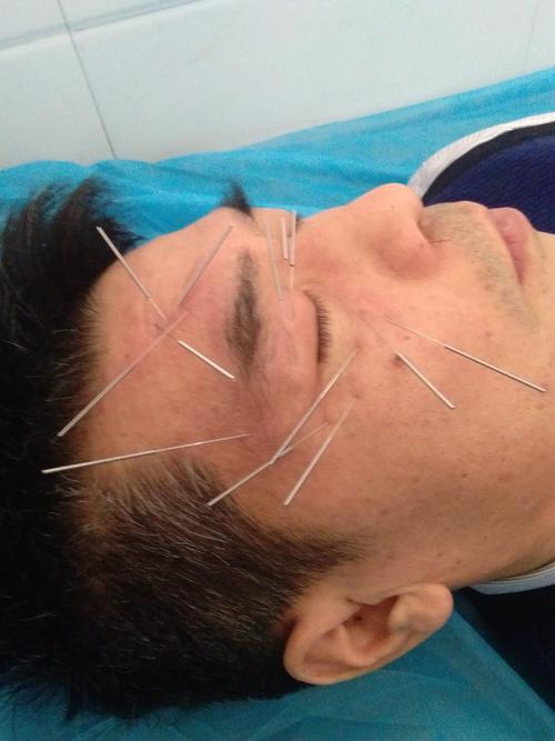 治疗面瘫的针灸图片