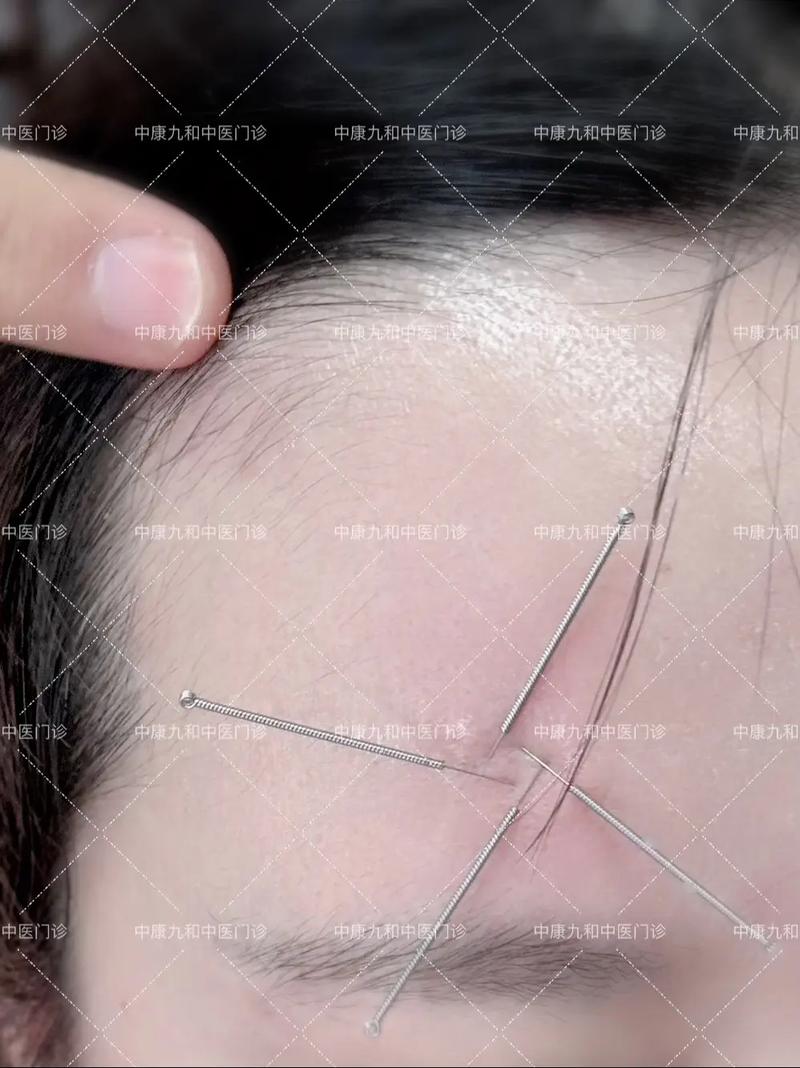 治疗面瘫的针灸图片