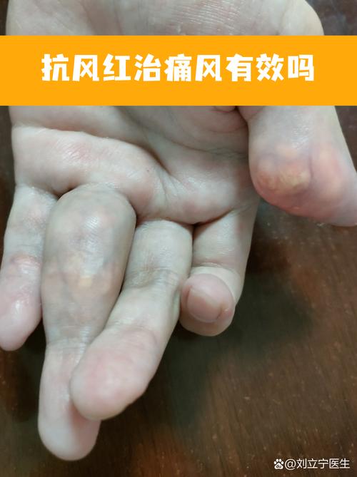 抗风红真的对痛风好吗