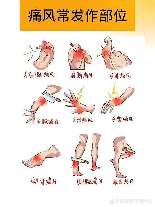 痛风表现的症状有哪些
