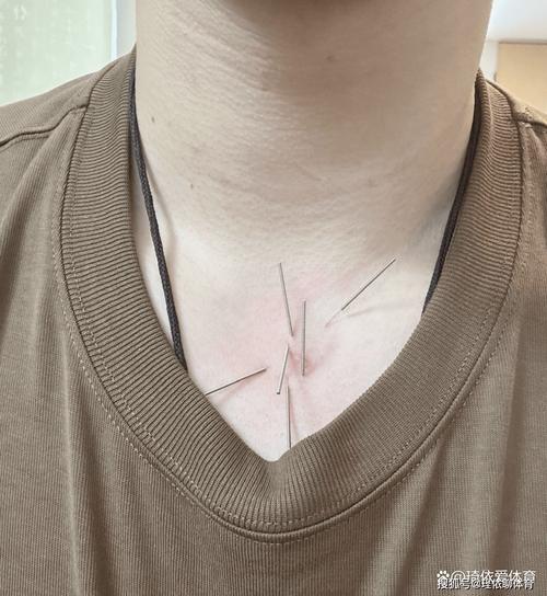 咽炎充血用针灸行吗