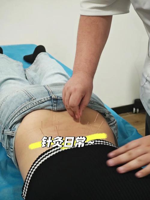 针灸真可以治疗腰痛