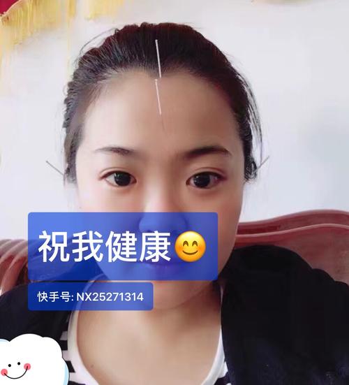 眼睑痉挛针灸能好吗