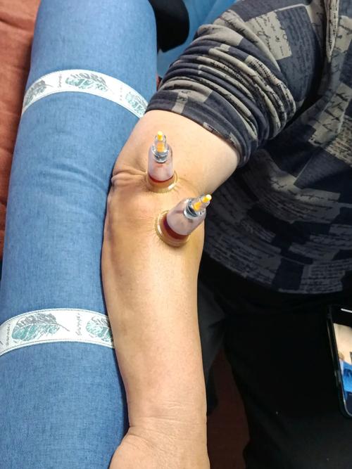 胳膊关节疼针灸行吗