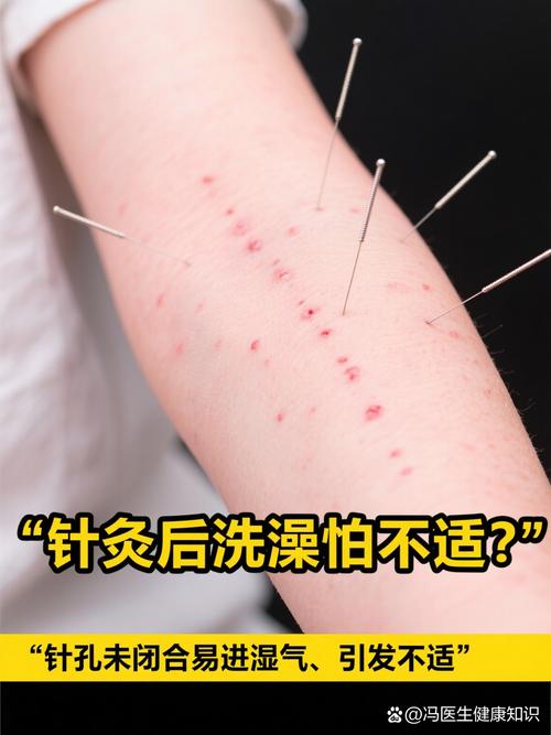 针灸完了还要打针吗