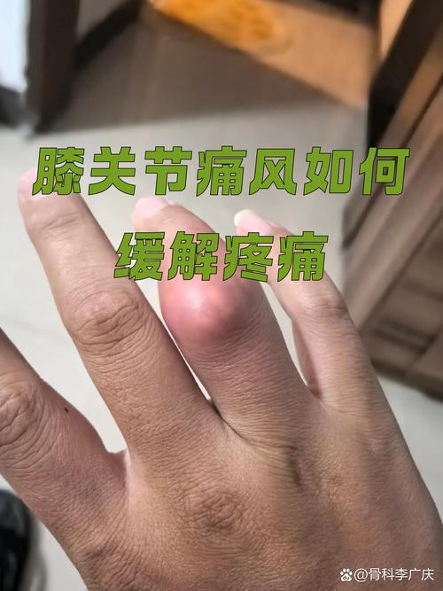 痛风膝盖肿了怎么消肿