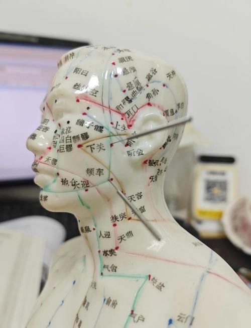 拔牙后多久可以针灸