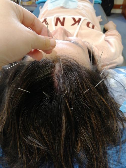 从急性头痛针灸治疗