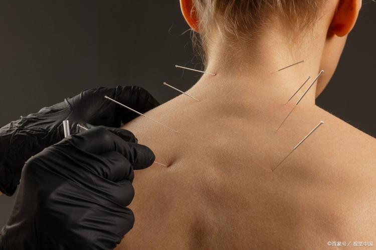 神经紊乱针灸扎哪里