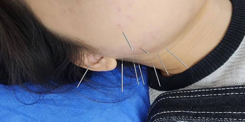 针灸治疗继发性痛经