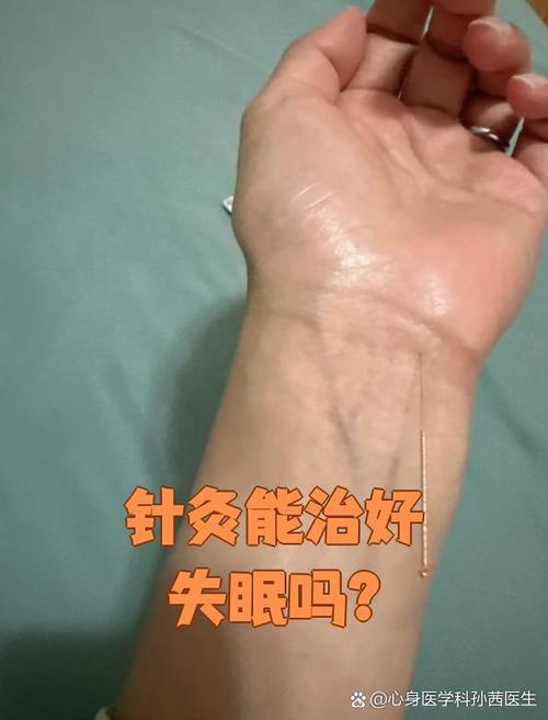 心悸与失眠针灸治疗