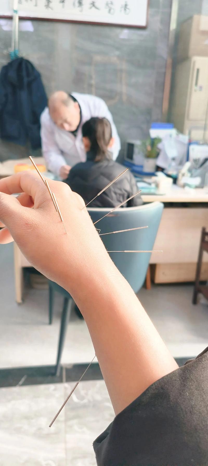 手指发麻可以针灸吗