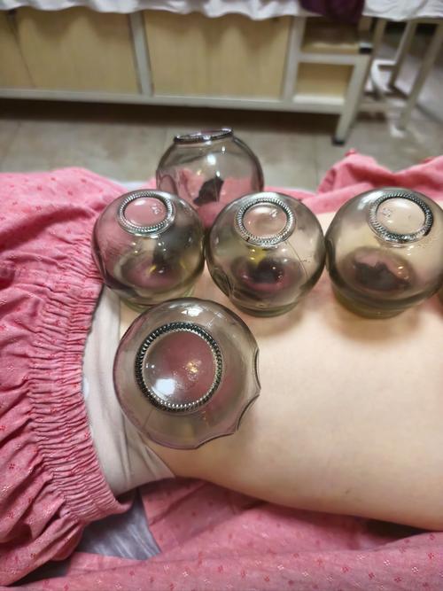 针灸拔火罐减肥反弹