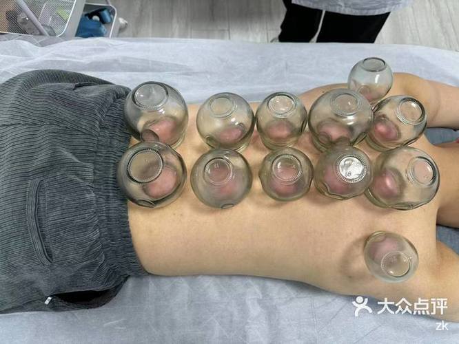 针灸拔火罐减肥反弹