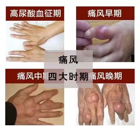 17岁痛风可以活多久