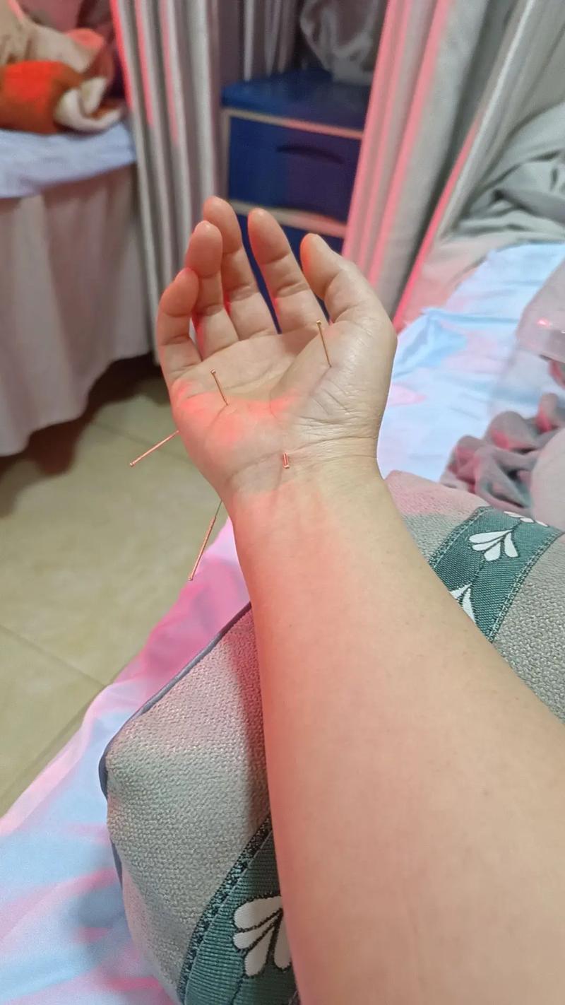 针灸治疗急性手挫伤