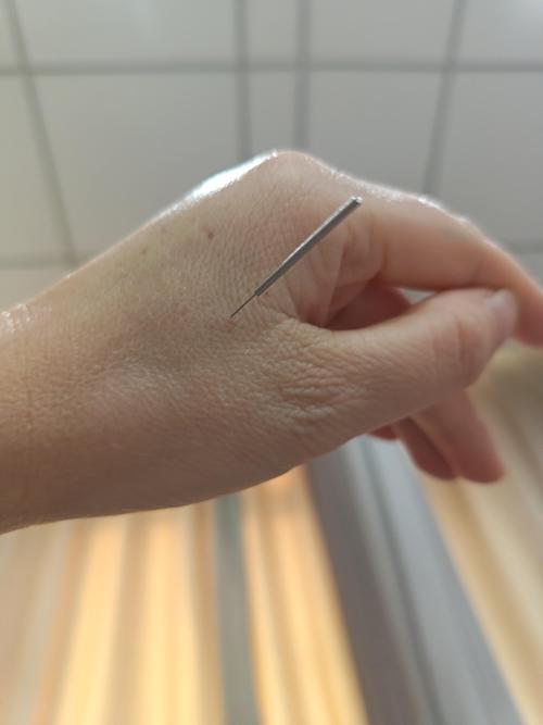 针灸治疗急性手挫伤