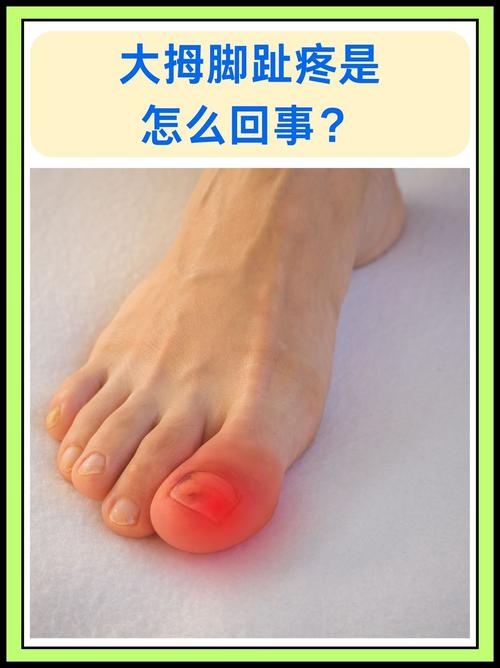 痛风脚趾疼痛的位置图