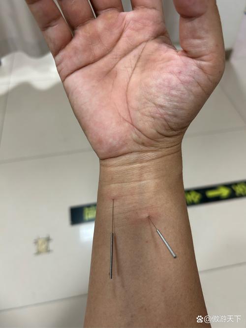 针灸治疗手指类风湿